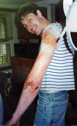 road rash